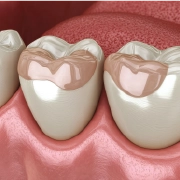 Dental bonding
