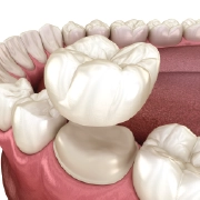 Dental crowns