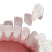 Porcelain veneers