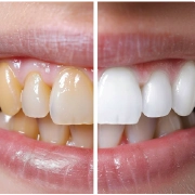 Teeth whitening