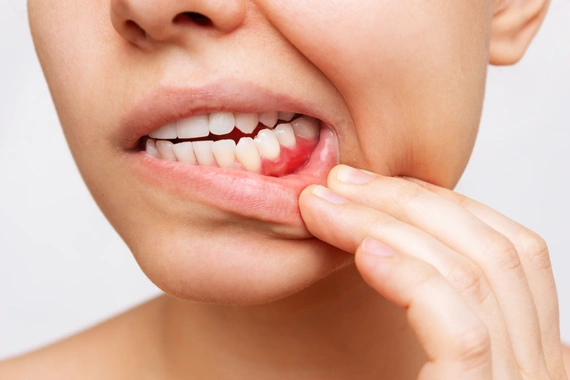 Clinical photo showing signs of gum disease — the kind of early-stage problem we look for and treat at every checkup