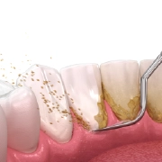 Dental cleaning illustration