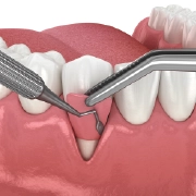 Gum treatment illustration