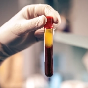 Platelet-Rich Fibrin treatment