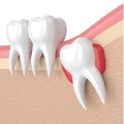 Wisdom teeth extraction