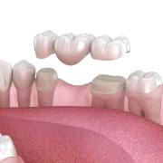 Dental crowns and bridges