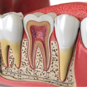 Root canal treatment