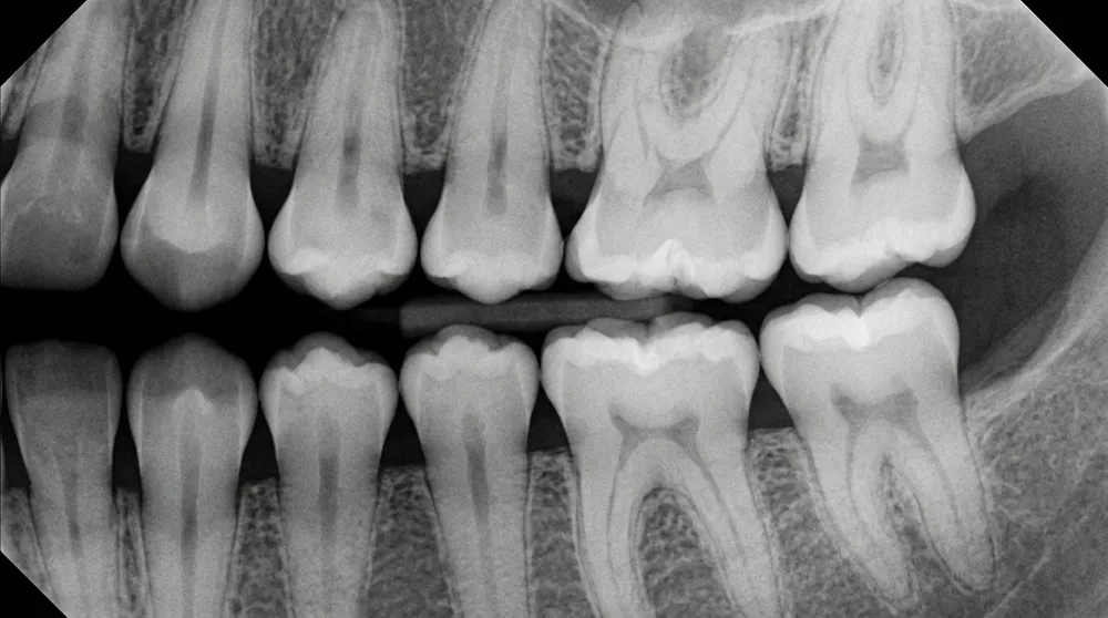 Dental bitewing X-ray showing premolars and molars in proper anatomical positions