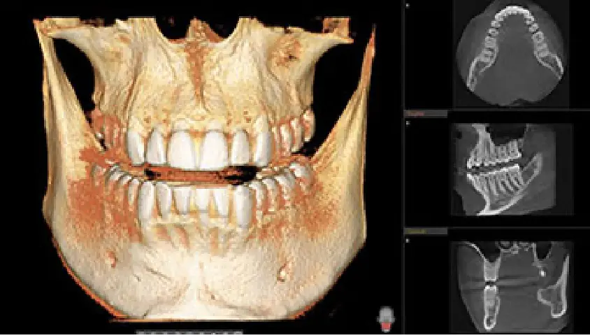 Cone beam CT 3D jaw scan used for precise dental implant planning