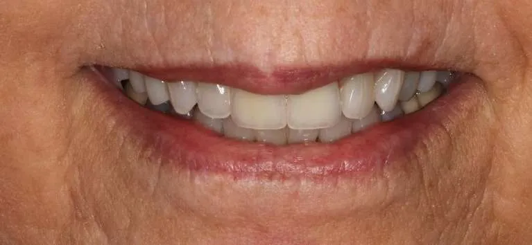 After porcelain crowns: uniform, polished smile