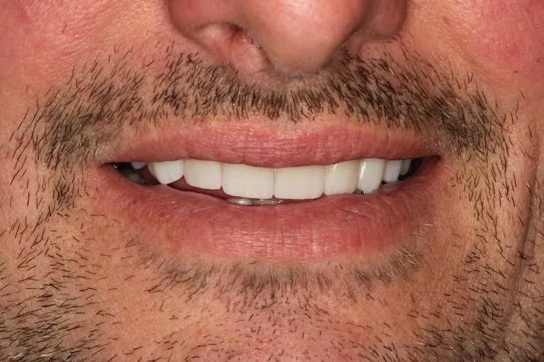 After porcelain crown and bonding: uniform, repaired smile
