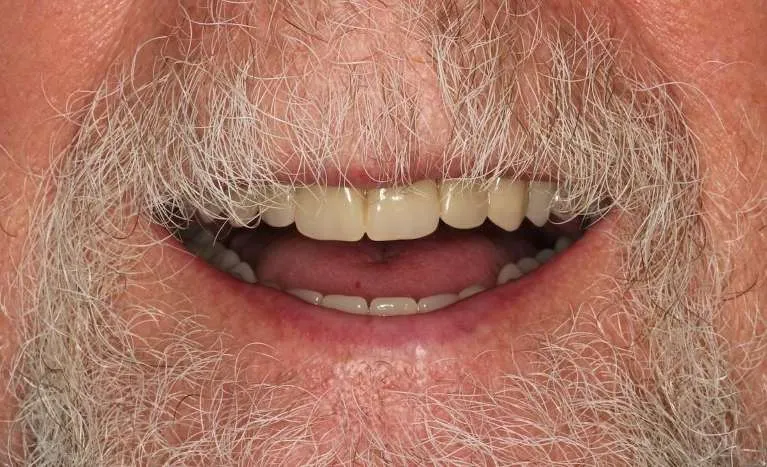 After implant dentures: full restored smile