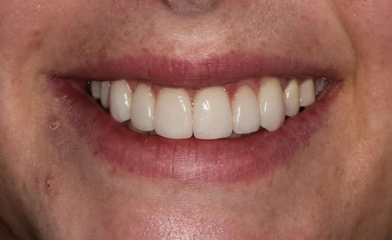 After porcelain veneers: uniform, symmetrical smile