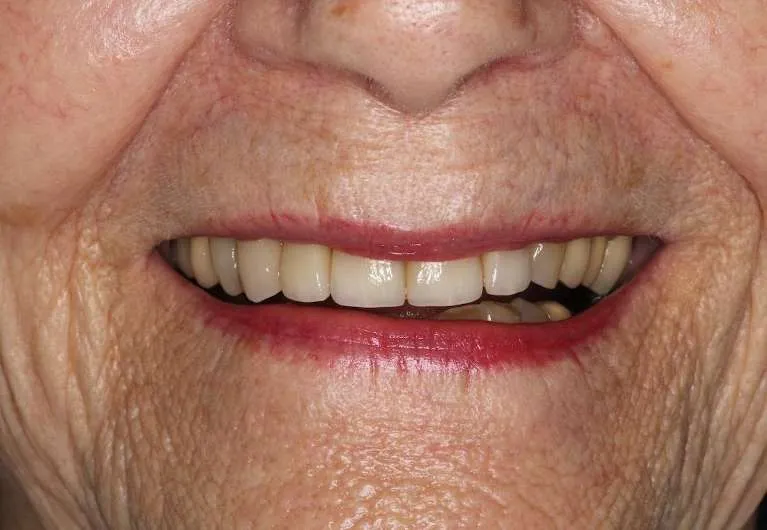 After porcelain crowns: restored, healthy smile