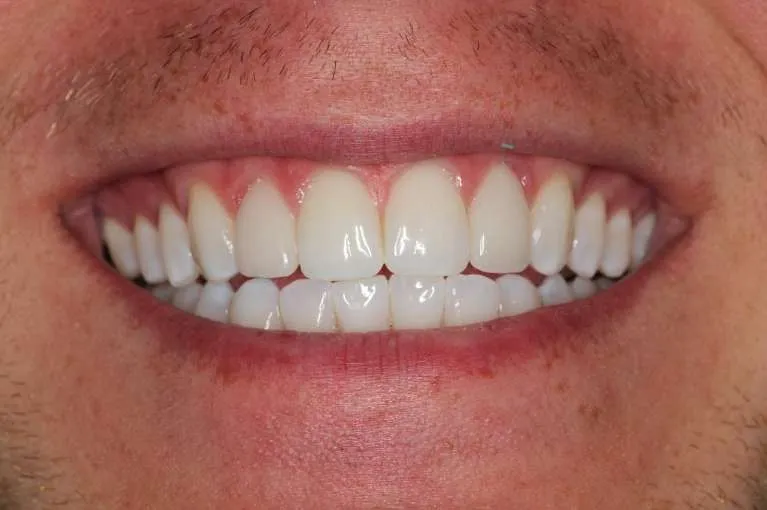After porcelain veneers: stunning smile