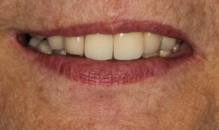 After dental implants and crowns: restored, confident smile