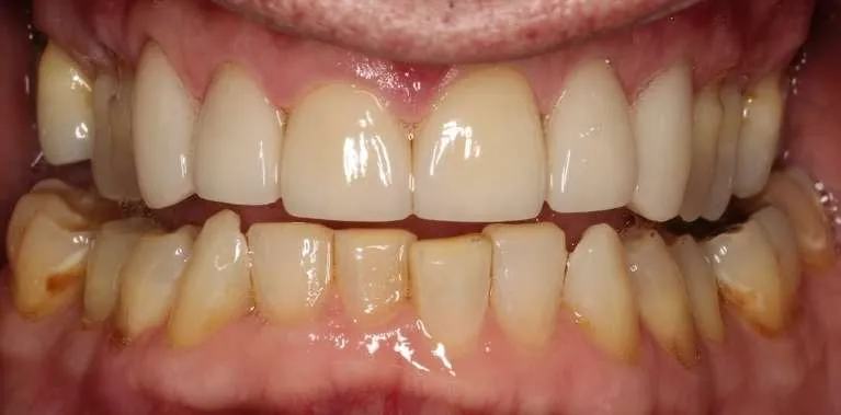 After porcelain crowns close-up: bright, comfortable smile