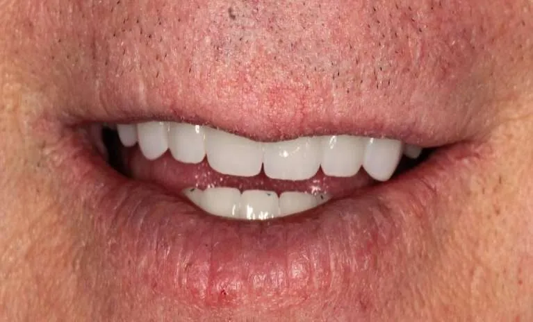 After porcelain bridge and crowns: rebuilt smile