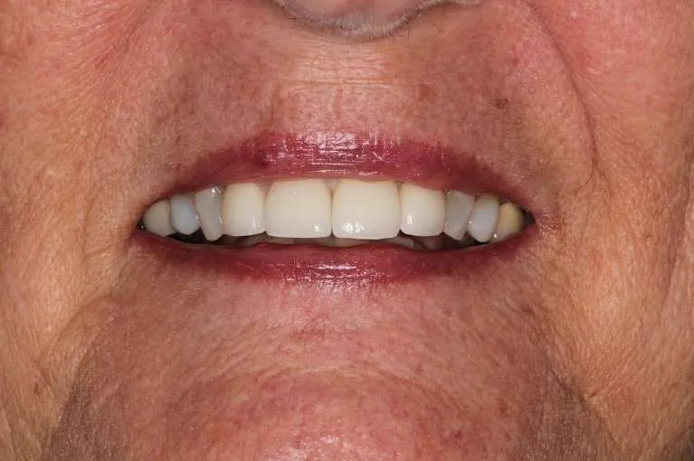 After porcelain crowns: full, beautiful smile