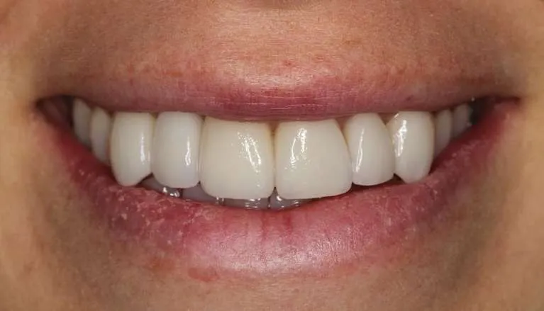 After implant, crowns, and veneers: symmetrical, uniform smile