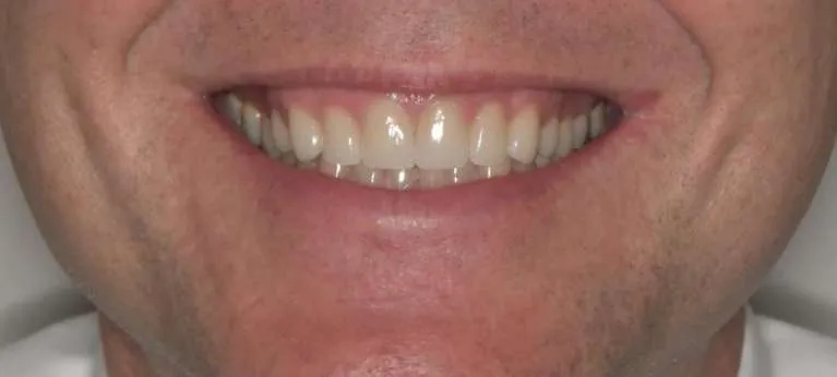 After porcelain crowns and veneers: bright, beautiful smile redesign