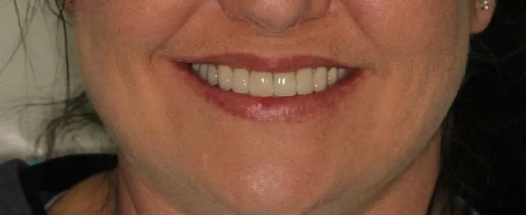 After porcelain crowns: uniform, bright smile