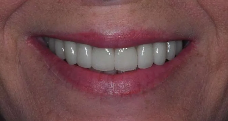 After porcelain crowns: radiant, aligned smile