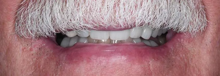 After porcelain crowns treatment: bright, uniform smile
