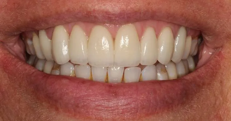 After porcelain veneers: uniform, radiant smile