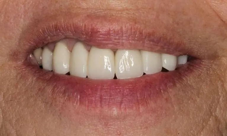 After eight porcelain crowns: brighter, more beautiful smile