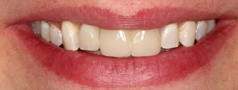 After dental implant and crowns: confident, complete smile