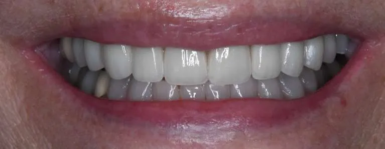 After teeth whitening, crowns, and implants: beautiful radiant smile