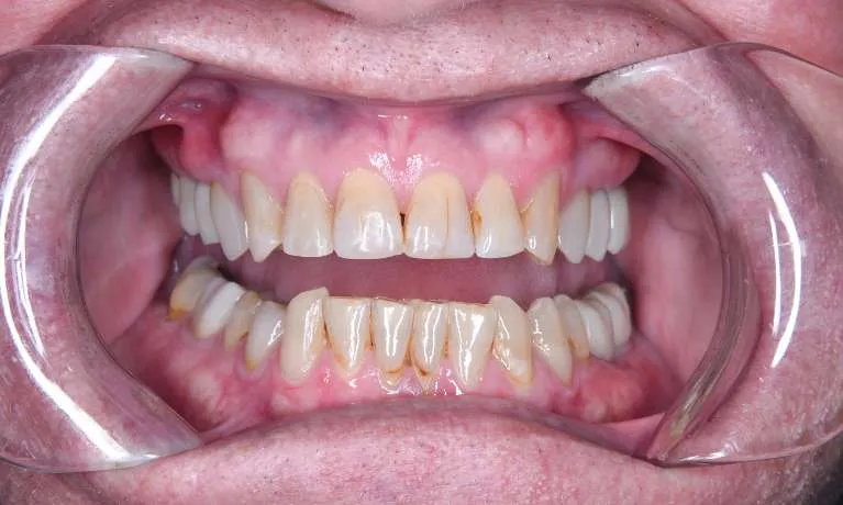 After comprehensive smile transformation: bright, complete smile