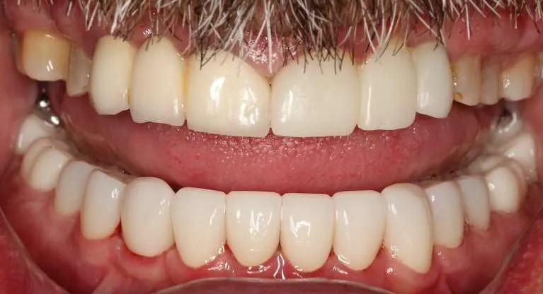 After porcelain crowns: rebuilt bite and improved aesthetics