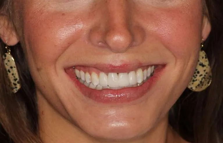 After customized porcelain crowns: natural, aesthetic smile