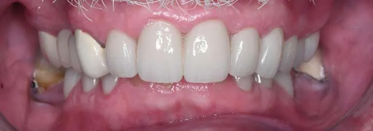 After porcelain crowns, second angle