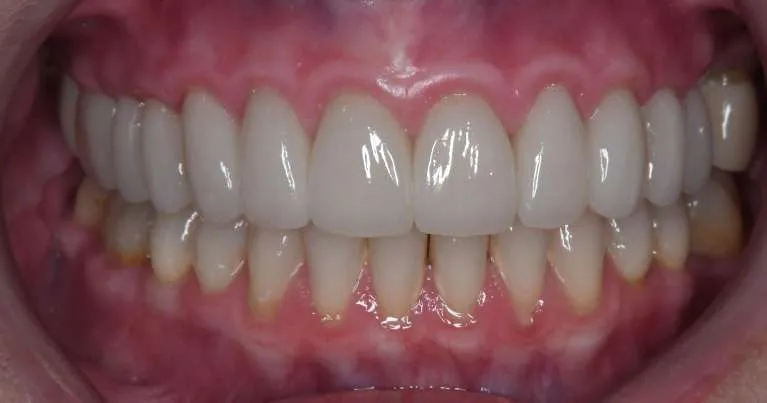 After porcelain crowns, second view
