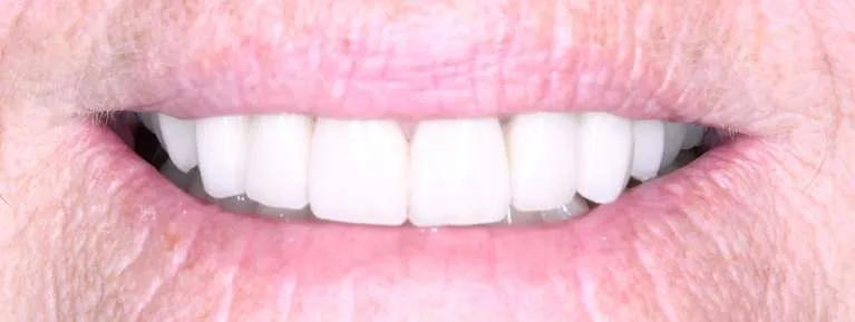 After teeth whitening, crowns, and bridge: beautiful enhanced smile