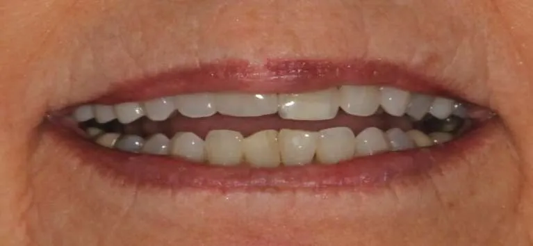 Before porcelain crowns: oddly shaped front teeth
