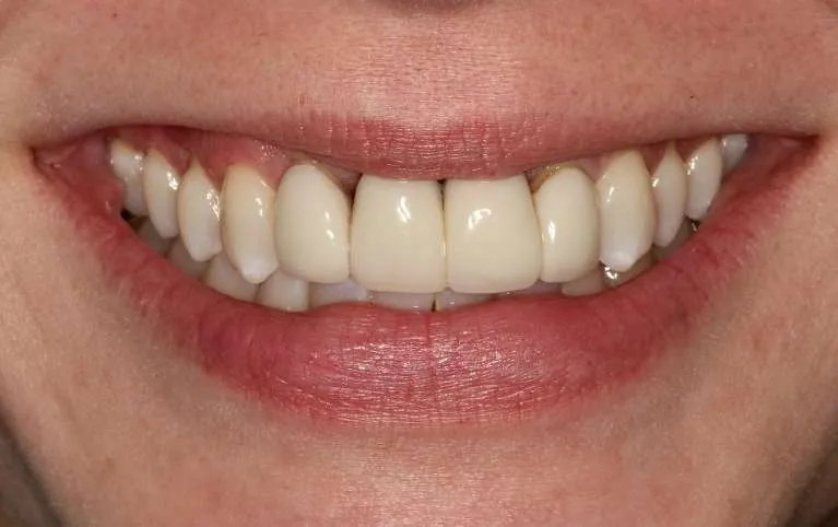 Before customized porcelain crowns: old crowns replaced