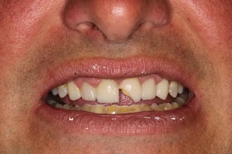 Before porcelain crown and bonding: severely broken front tooth