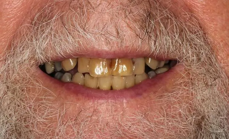 Before implant-supported dentures: broken and stained teeth