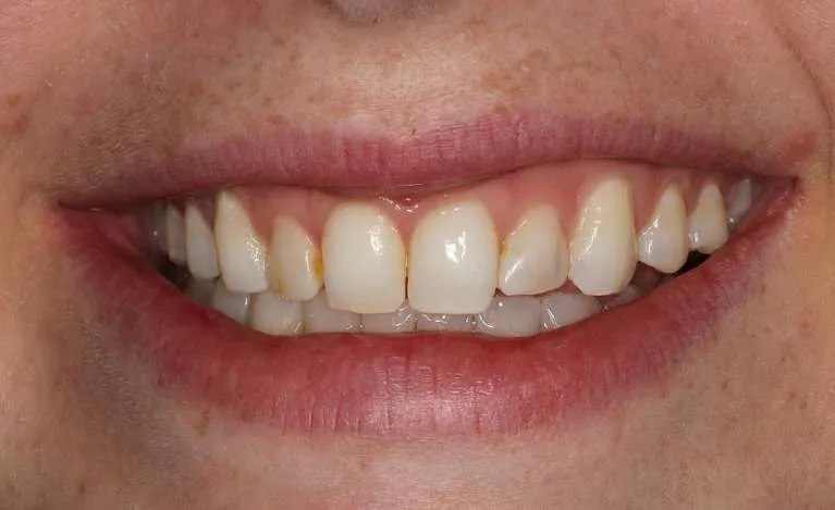 Before porcelain veneers: discolored and misshapen front teeth