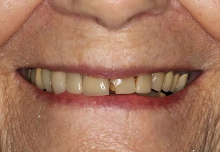 Before porcelain crowns: broken and decayed teeth