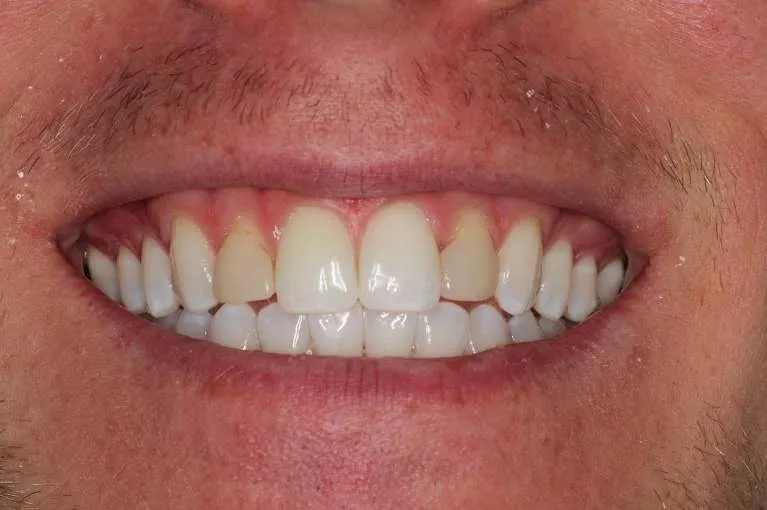 Before porcelain veneers: discolored teeth