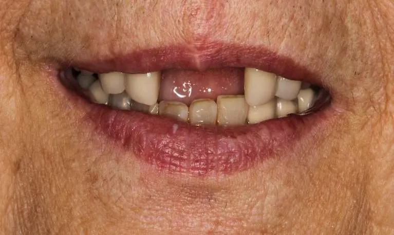 Before dental implants and crowns: missing and compromised teeth