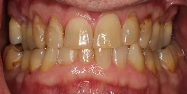 Before porcelain crowns close-up: worn, decayed, and discolored teeth