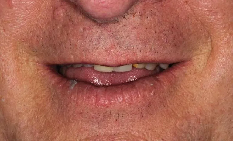 Before porcelain bridge and crowns: missing and compromised teeth