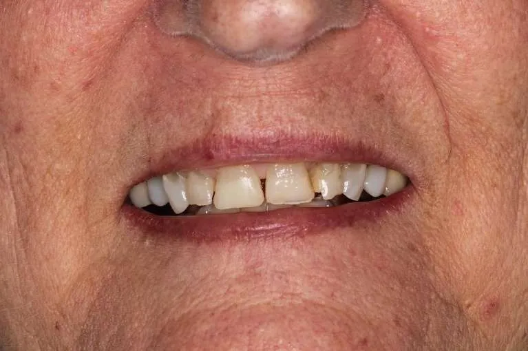 Before porcelain crowns: misshapen teeth