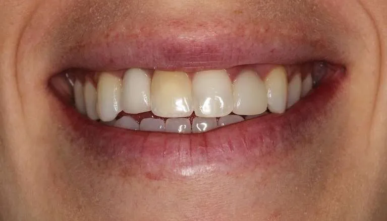 Before: dead and discolored front tooth with surrounding misalignment